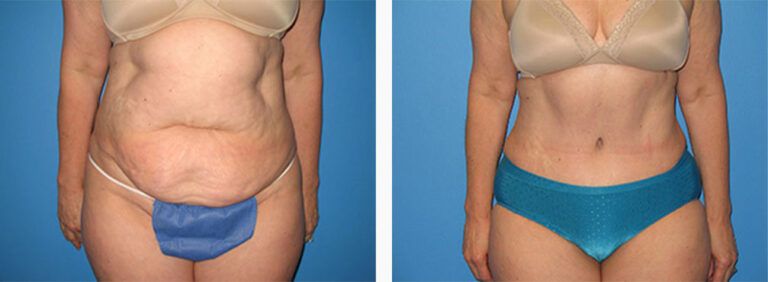 Abdominoplasty-Case-20-1