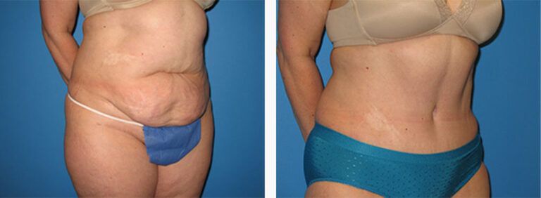 Abdominoplasty-Case-20-2