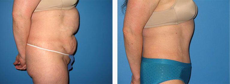 Abdominoplasty-Case-20-3