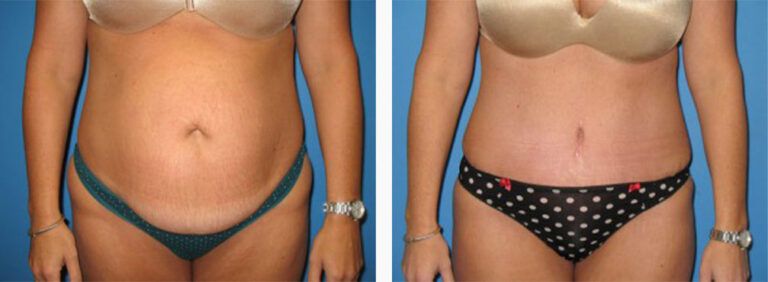 Abdominoplasty-Case-21-1