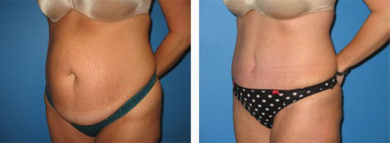 Abdominoplasty-Case-21-2