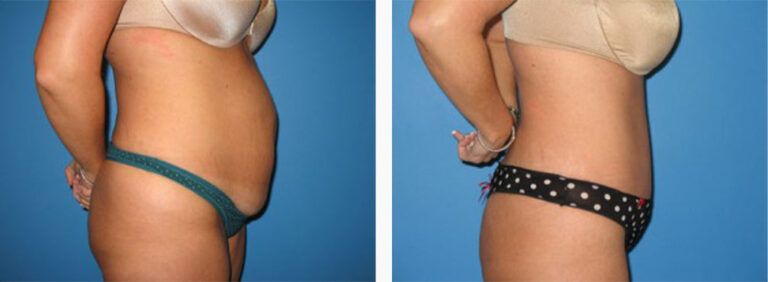 Abdominoplasty-Case-21-3