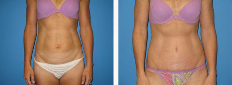 Abdominoplasty-Case-22-1