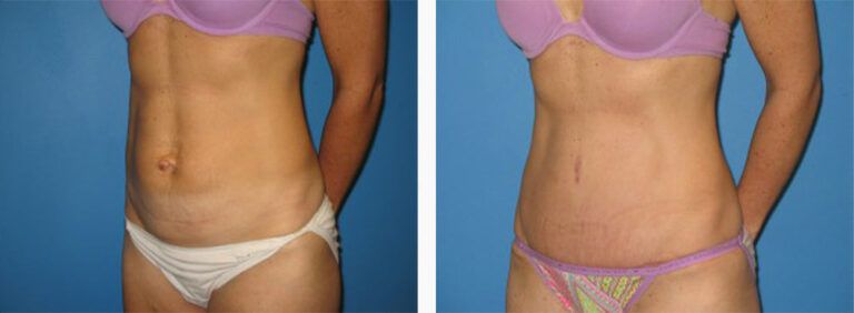 Abdominoplasty-Case-22-2