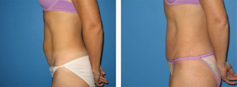 Abdominoplasty-Case-22-3