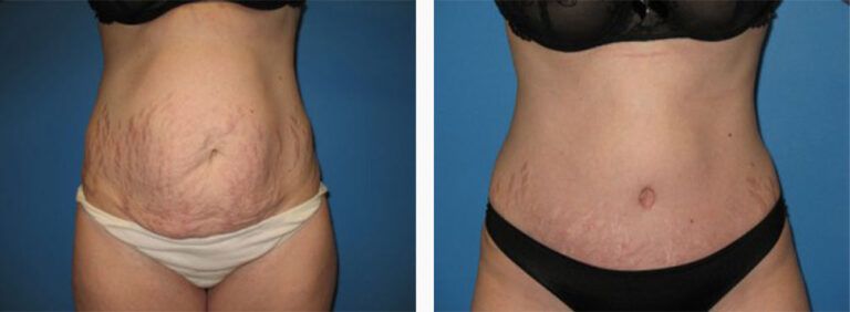 Abdominoplasty-Case-23-1