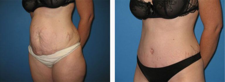 Abdominoplasty-Case-23-2