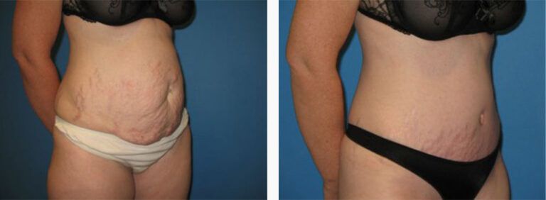 Abdominoplasty-Case-23-3
