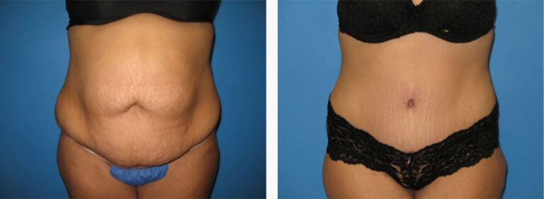 Abdominoplasty-Case-24-1