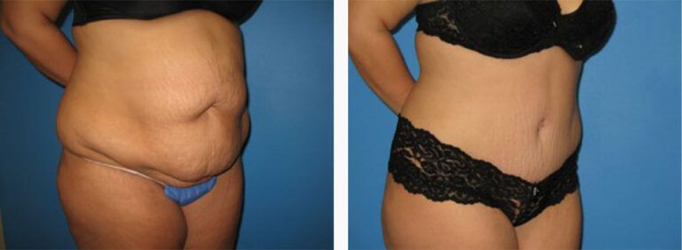 Abdominoplasty-Case-24-2