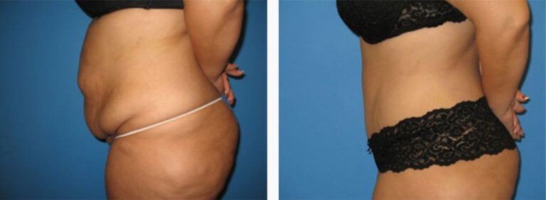 Abdominoplasty-Case-24-3