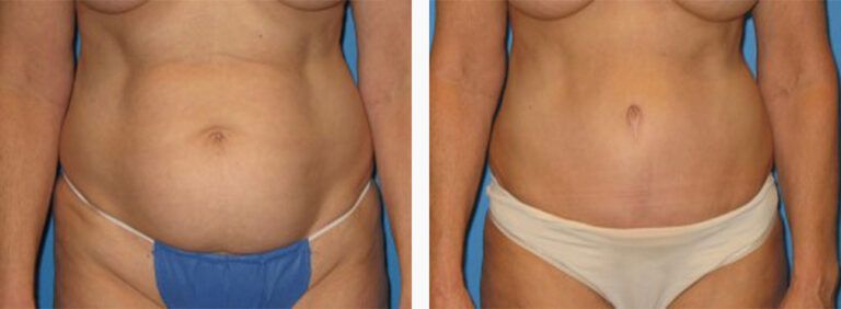 Abdominoplasty-Case-25-1
