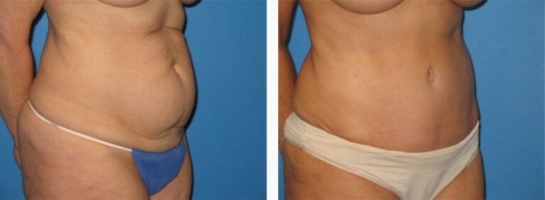 Abdominoplasty-Case-25-2