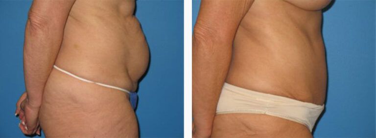 Abdominoplasty-Case-25-3