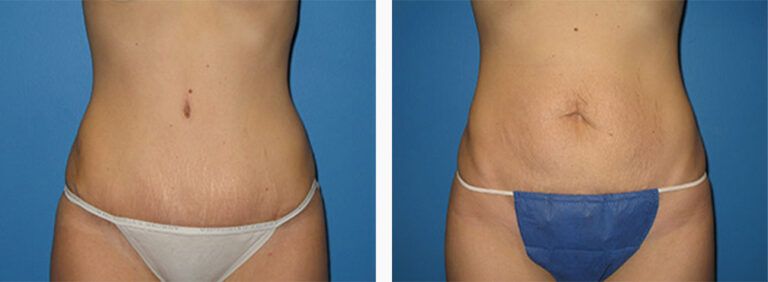 Abdominoplasty-Case-26-1