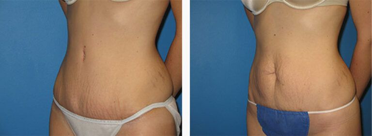 Abdominoplasty-Case-26-2