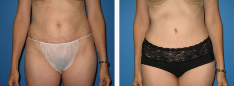 Abdominoplasty-Case-27-1