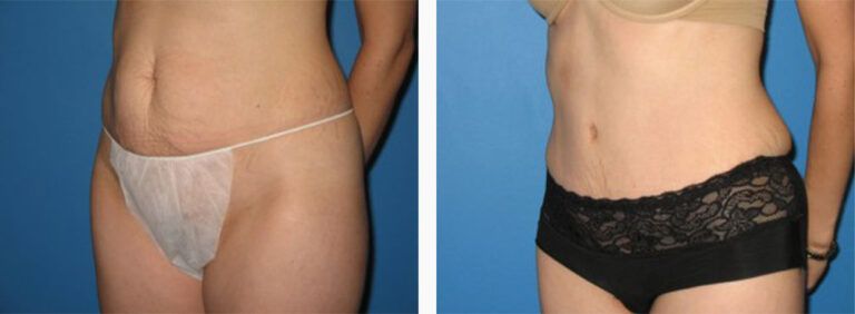 Abdominoplasty-Case-27-2