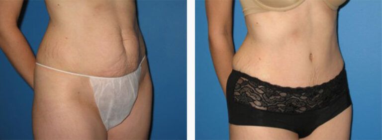Abdominoplasty-Case-27-3