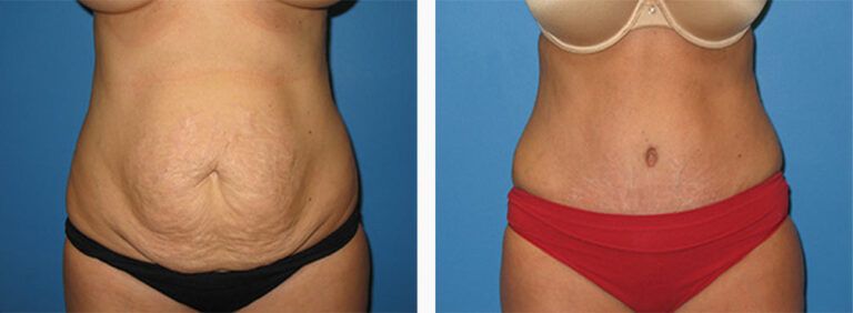 Abdominoplasty-Case-28-1