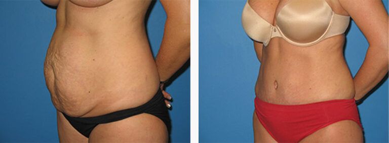 Abdominoplasty-Case-28-2