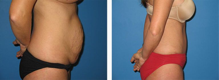 Abdominoplasty-Case-28-3