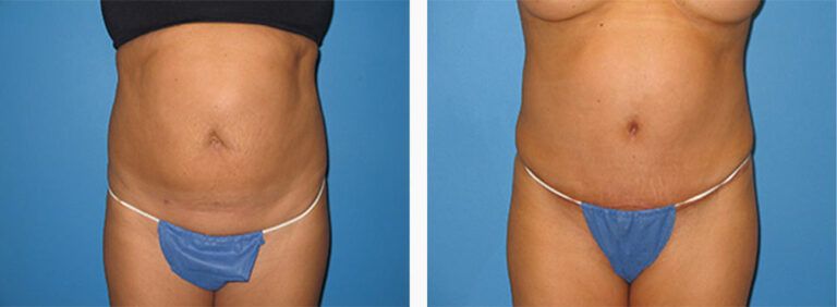 Abdominoplasty-Case-29-1