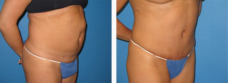 Abdominoplasty-Case-29-2