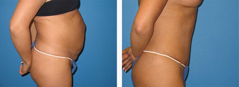 Abdominoplasty-Case-29-3