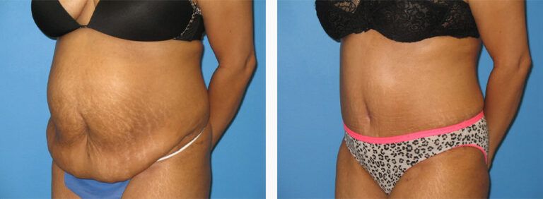 Abdominoplasty-Case-30-2