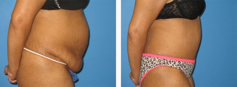 Abdominoplasty-Case-30-3