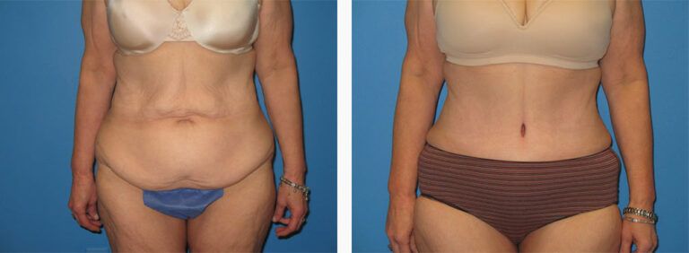 Abdominoplasty-Case-31-1