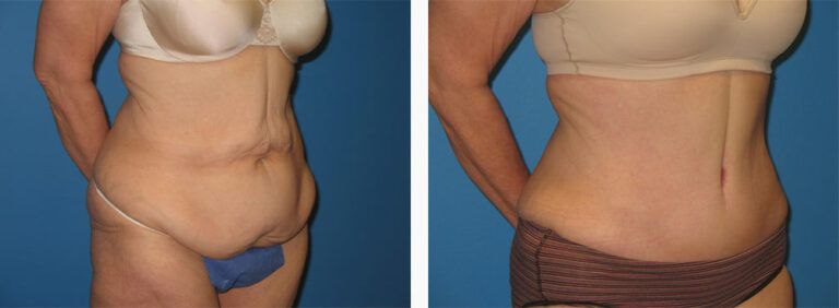 Abdominoplasty-Case-31-2