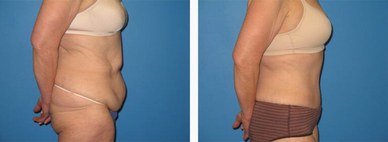 Abdominoplasty-Case-31-3