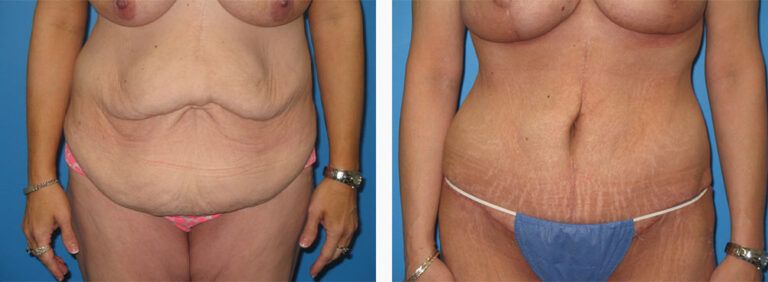 Abdominoplasty-Case-32-1