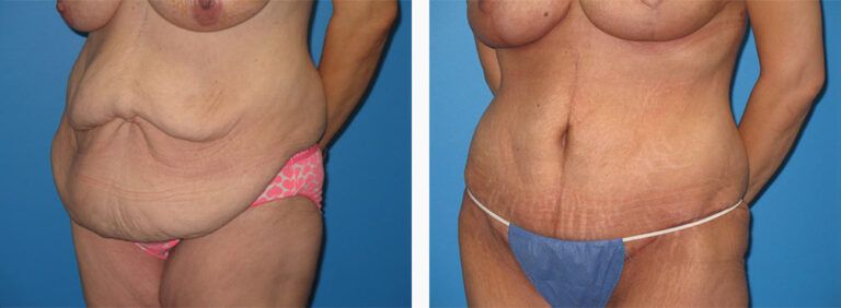 Abdominoplasty-Case-32-2