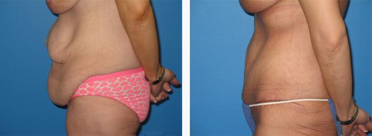 Abdominoplasty-Case-32-3