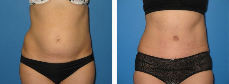 Abdominoplasty-Case-33-1