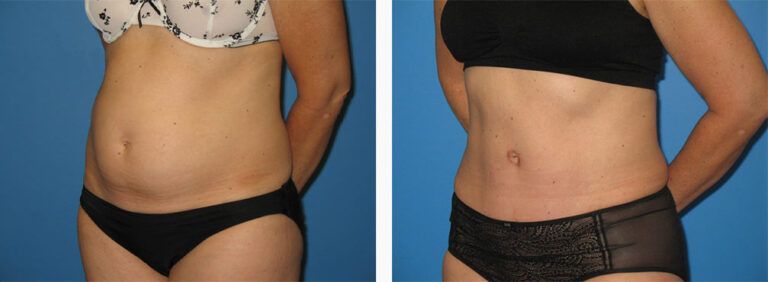 Abdominoplasty-Case-33-2