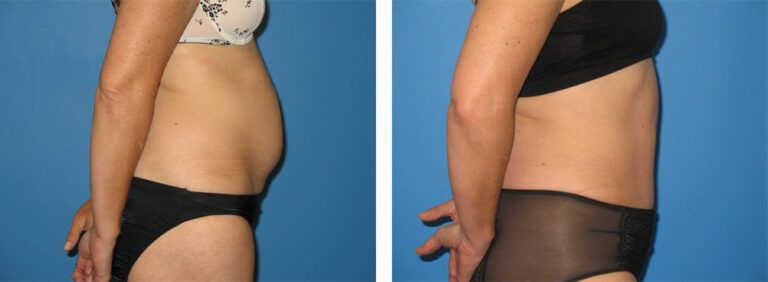 Abdominoplasty-Case-33-3