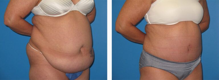 Abdominoplasty-Case-34-2