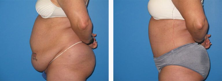 Abdominoplasty-Case-34-3
