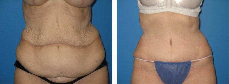 Abdominoplasty-Case-35-1