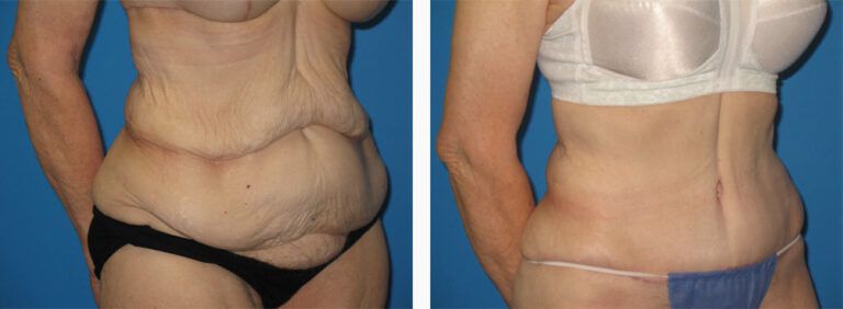 Abdominoplasty-Case-35-2