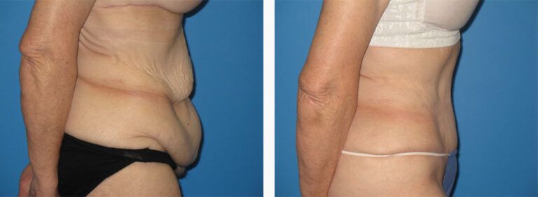 Abdominoplasty-Case-35-3