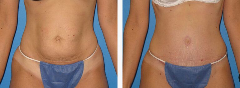 Abdominoplasty-Case-36-1