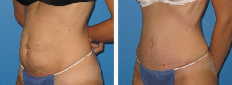 Abdominoplasty-Case-36-2