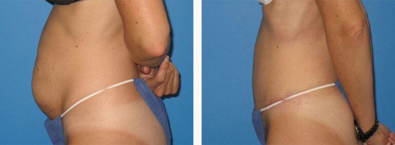 Abdominoplasty-Case-36-3