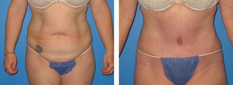 Abdominoplasty-Case-37-1