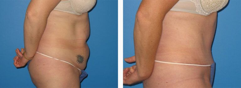 Abdominoplasty-Case-37-3